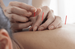 Health Conditions That Acupuncture Can Treat