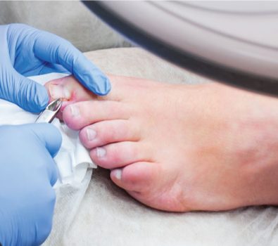 ingrown toenail surgery