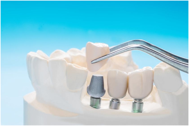 Benefits Of Getting Dental Implants